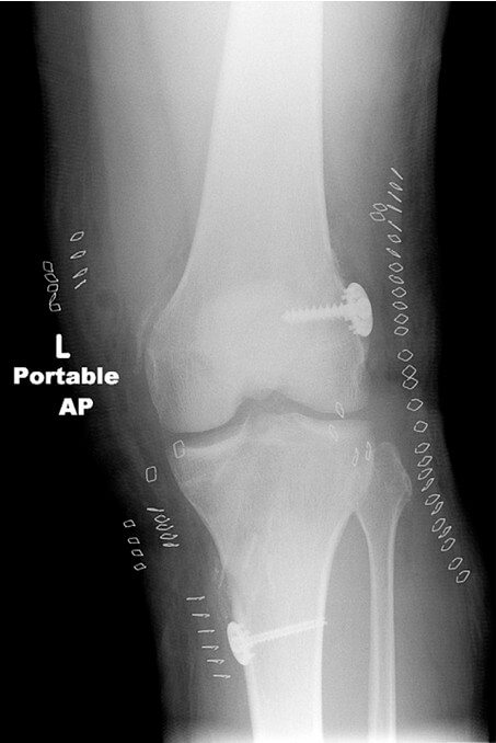 Операция колено пкс. Рентген коленного сустава ПКС. Пластика ПКС коленного сустава рентген. Операция на крестообразной связки рентген. Операция на связках коленного сустава рентген.